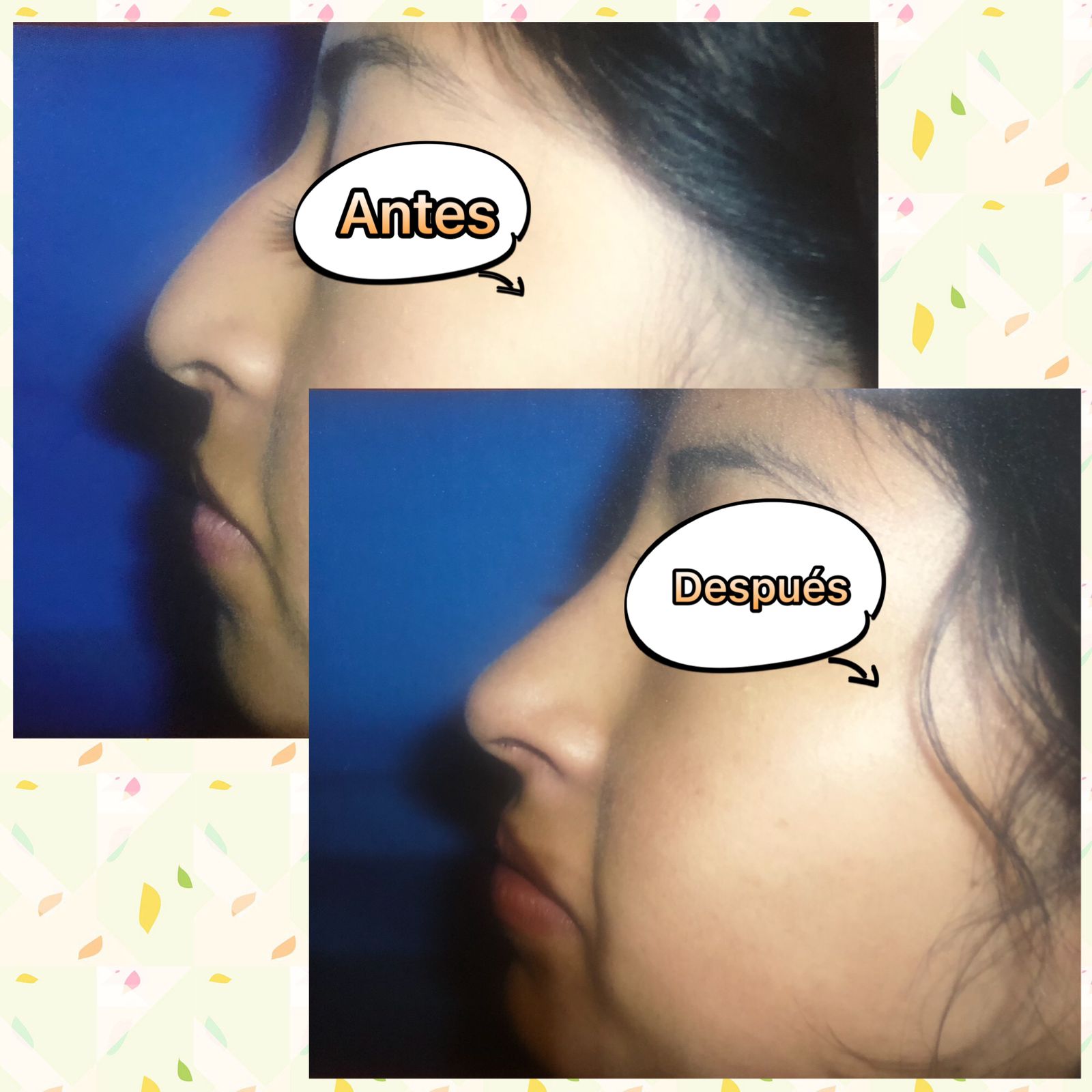 Cirugia Estetica de Nariz - Otorrinolaringología Especializada