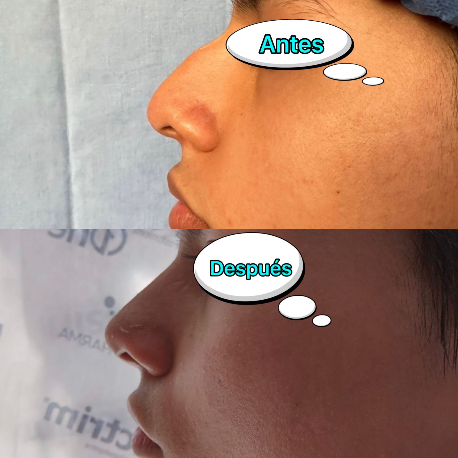 Cirugia Estetica de Nariz - Otorrinolaringología Especializada